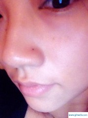 鼻翼两侧长痣(鼻翼两侧长痣什么原因引起)