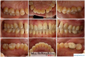 梦见牙齿掉光了(梦见牙齿掉光了是什么征兆)