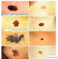 痣上长毛(痣上长毛怎么去掉)