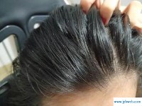 梦见自己掉头皮屑(梦见自己掉头皮屑是啥意思)