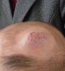 脸上胎记的位置与命运（ 身上的胎记与前世 ）